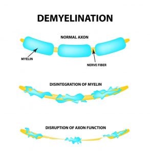 demyelination2