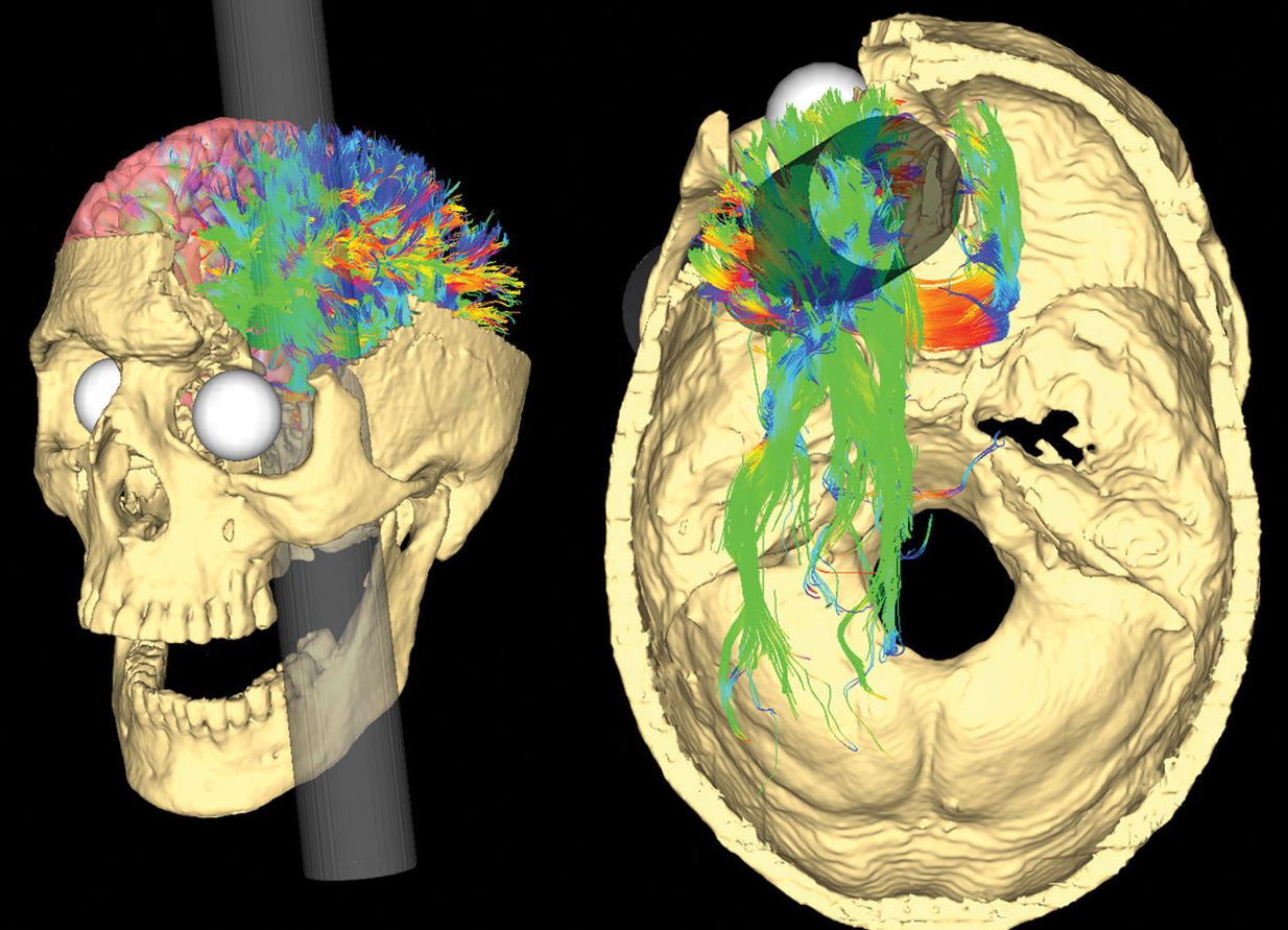 Phineas Gage MRI brain image from Van Horn et al., (2012) 